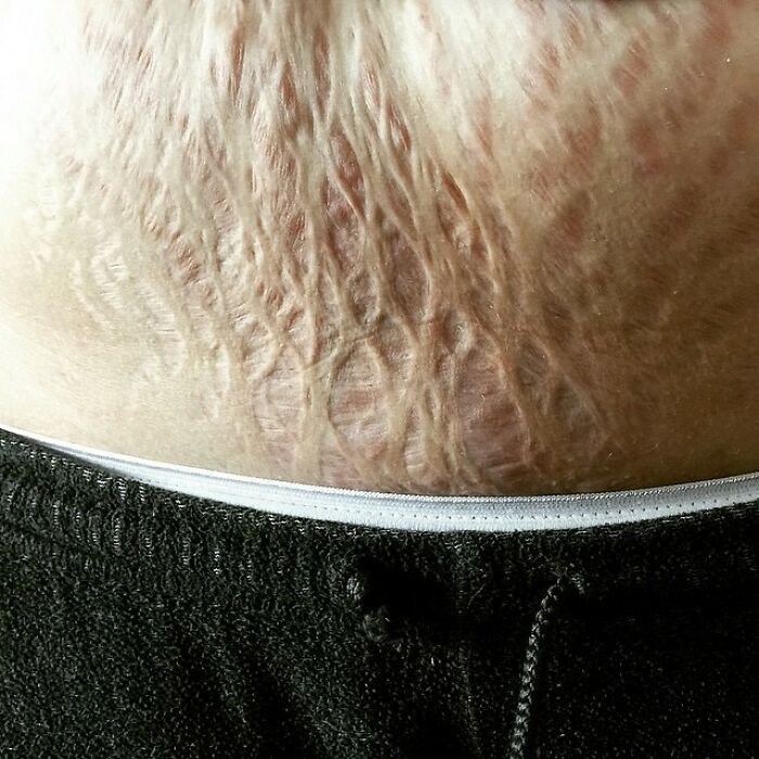 STRETCH MARKS REVISION