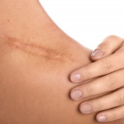 HYPERTROPHIC SCARS REVISION