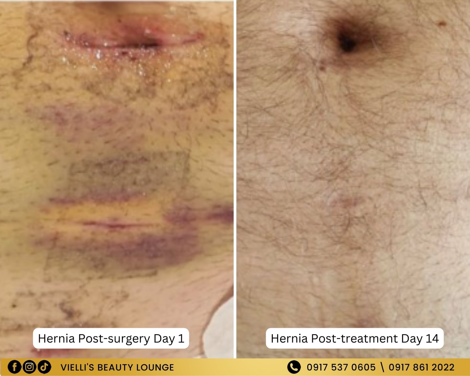 SCAR-LESS WOUND SOLUTION